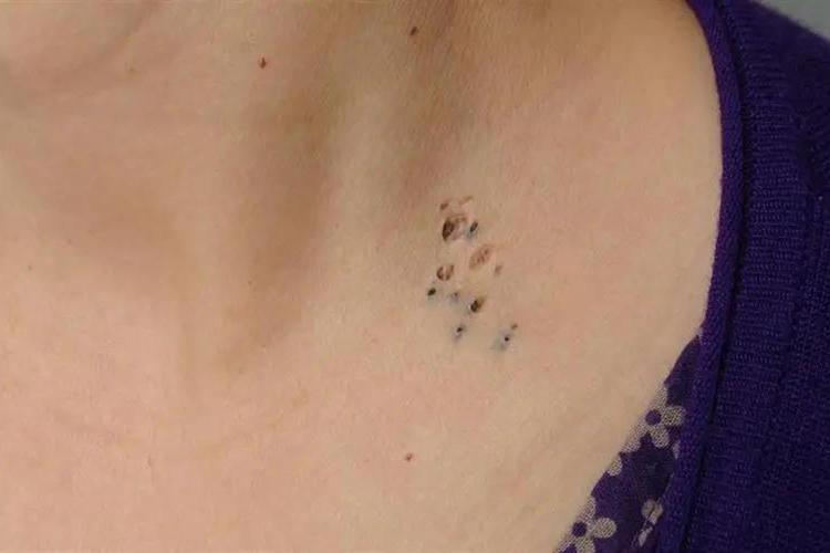 胸前黑头粉刺样痣图