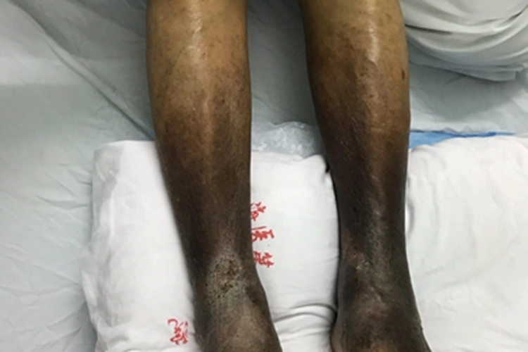 闭塞性血栓性脉管炎皮肤发黑图