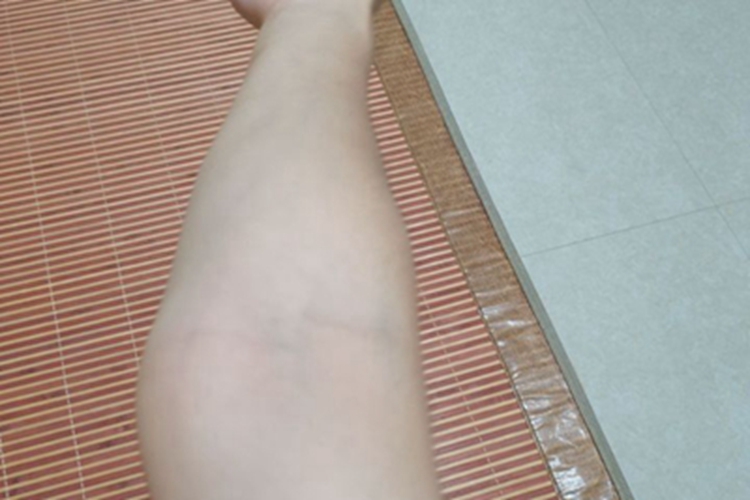 肘外翻手臂畸形向外翻图