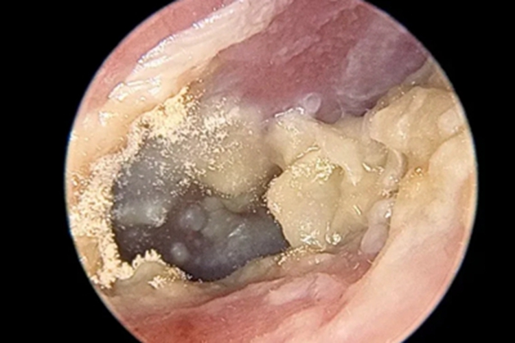 霉菌性外耳道炎外耳道化脓图 霉菌性外耳道炎外耳道化脓图