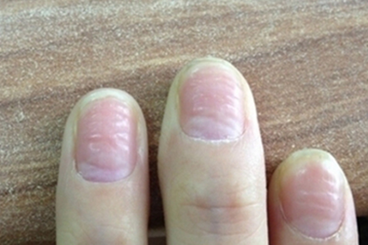 甲凹点指甲表面有小坑图