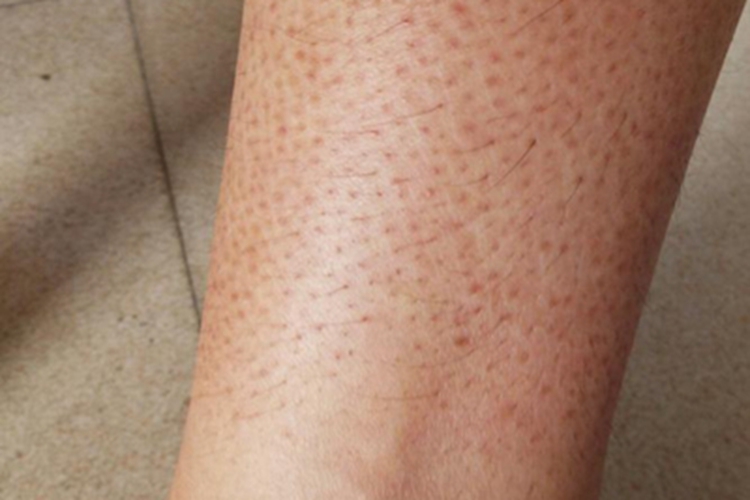 毛囊角化病小腿黑斑图
