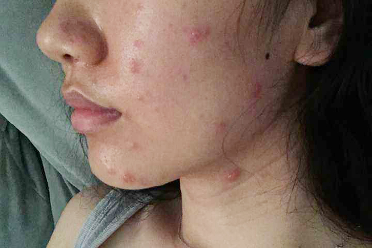 女性面部疱疹水痘图