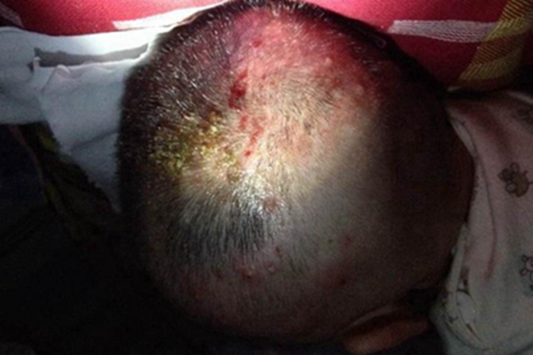 毛囊炎头皮症状图 毛囊炎头皮症状图