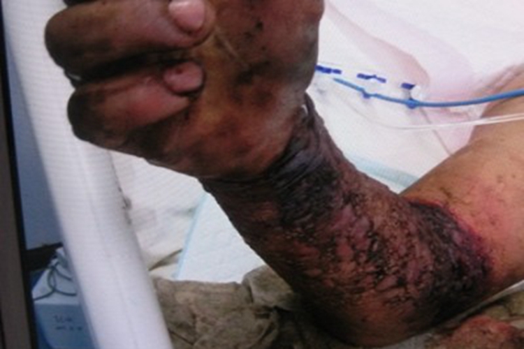 蛇咬伤胳膊红肿图 蛇咬伤胳膊红肿图