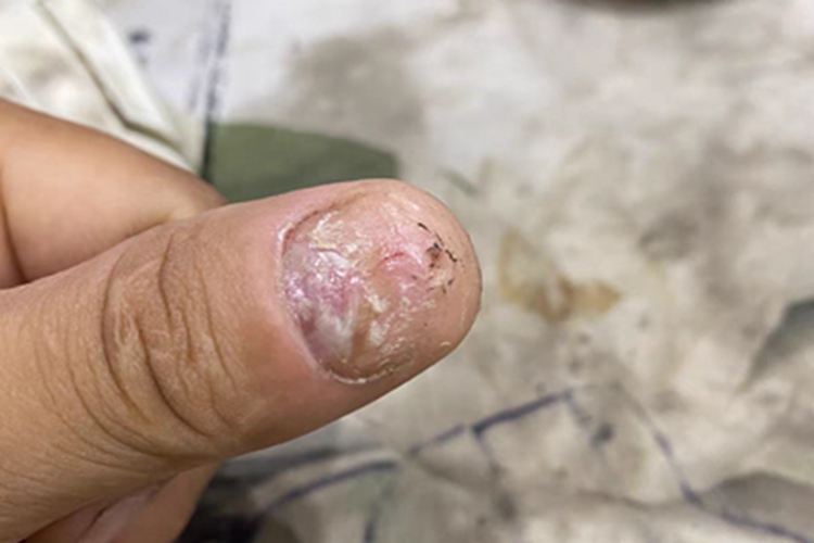 全甲损毁型甲真菌病手指甲图 全甲损毁型甲真菌病手指甲图