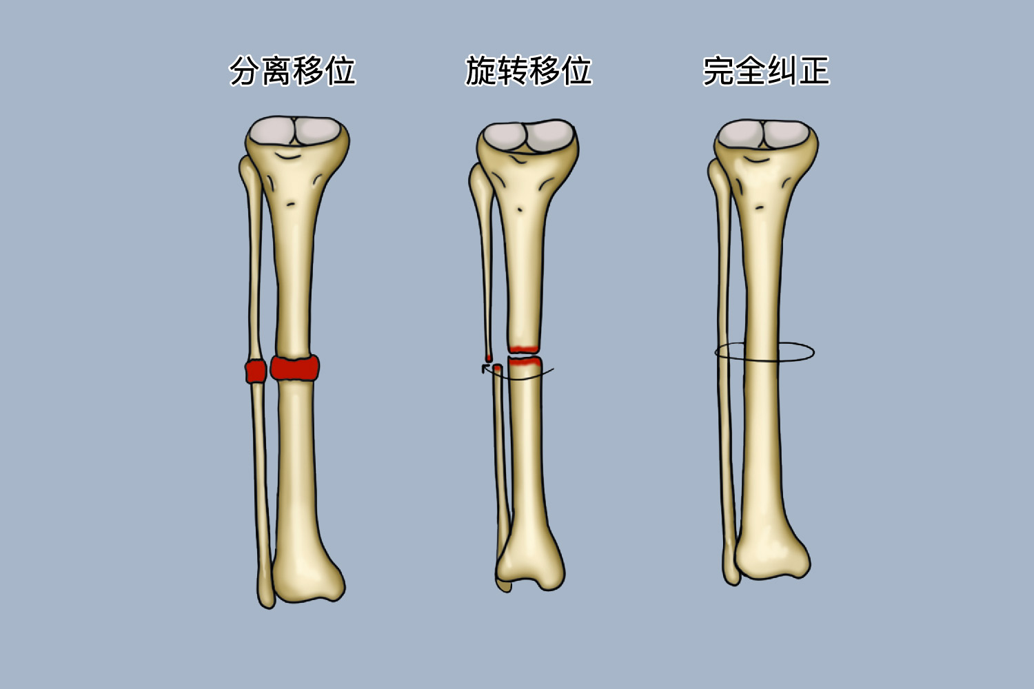 儿童骨折复位对线标准图