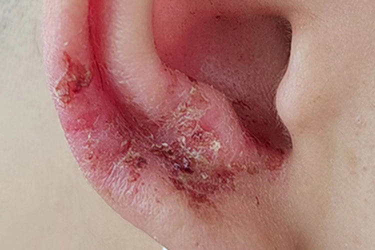 感染性湿疹耳廓血痂图 感染性湿疹耳廓血痂图