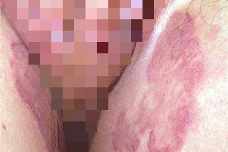 股癣大腿红斑图 股癣大腿红斑图