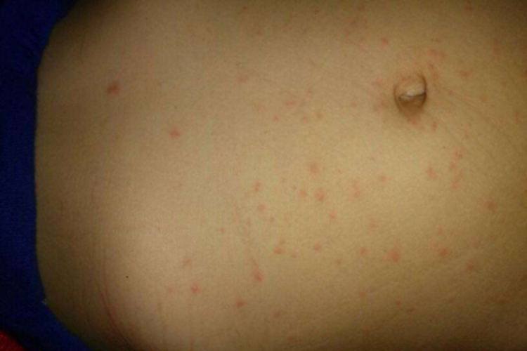 铜绿假单胞菌毛囊炎腹部症状图