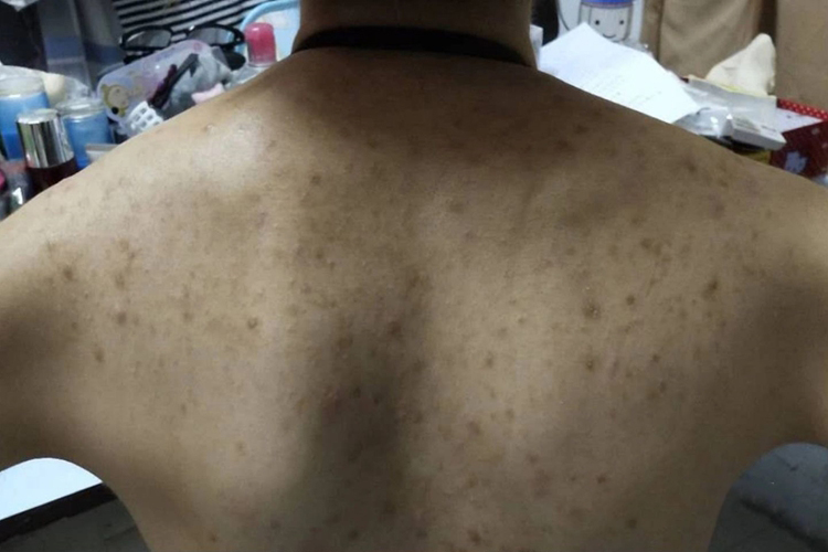 毛囊炎留下的黑印图