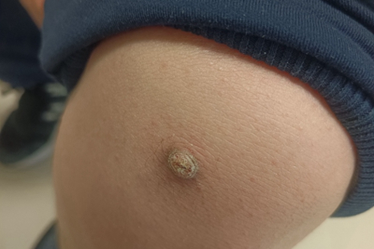 寻常疣膝盖疙瘩图