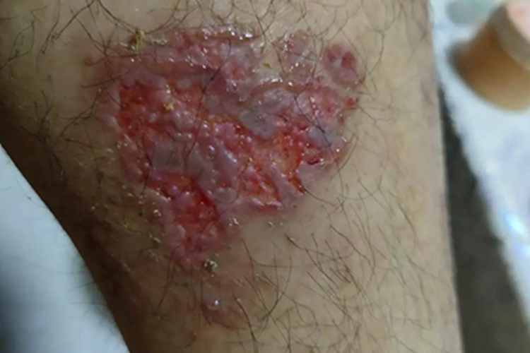 急性湿疹溃疡图 急性湿疹溃疡图