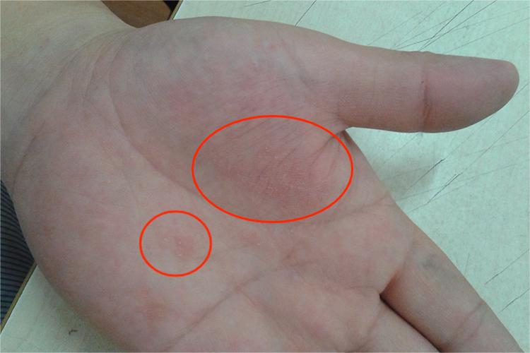 小孩手掌心汗疱疹图