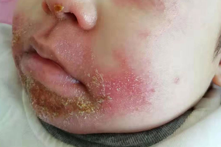 婴儿脂溢性湿疹图