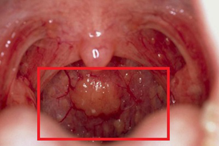 慢性咽炎咽喉疙瘩图