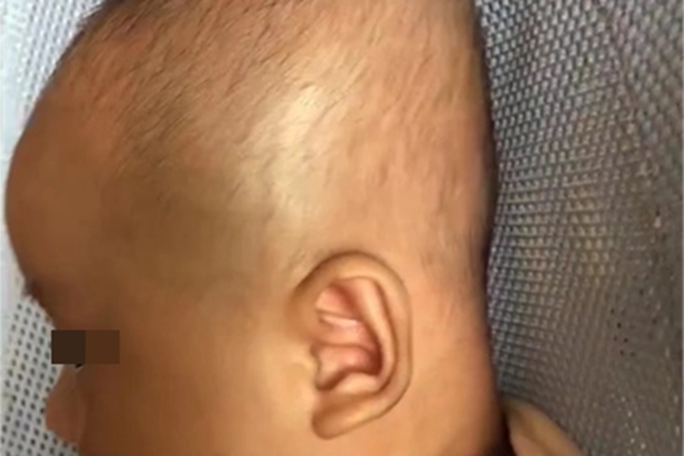 5P-综合征后脑勺扁平变形图