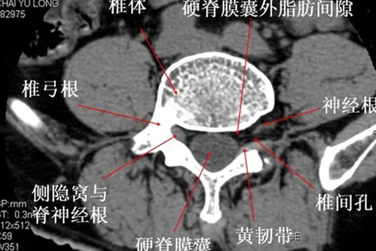 腰椎侧隐窝CT位置图 腰椎侧隐窝CT位置图