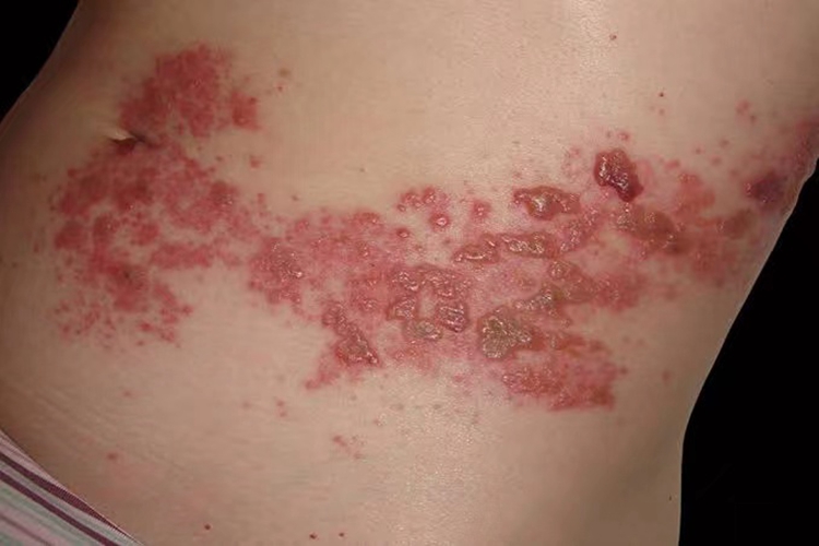 艾滋病患者带状疱疹图