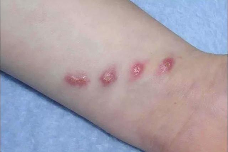 红斑性丘疹图 红斑性丘疹图