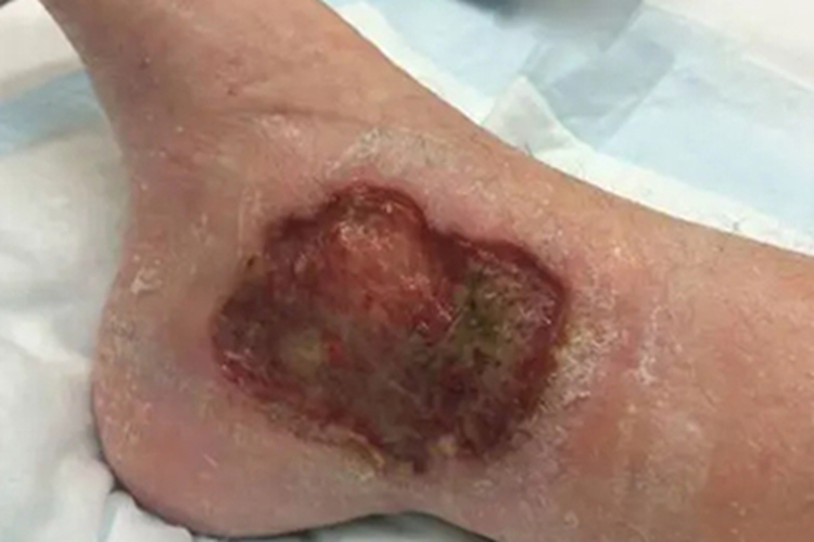 坏疽性脓皮病脚踝溃疡图 坏疽性脓皮病脚踝溃疡图