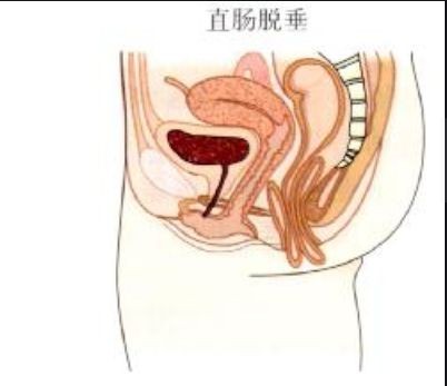 女性直肠脱垂图片