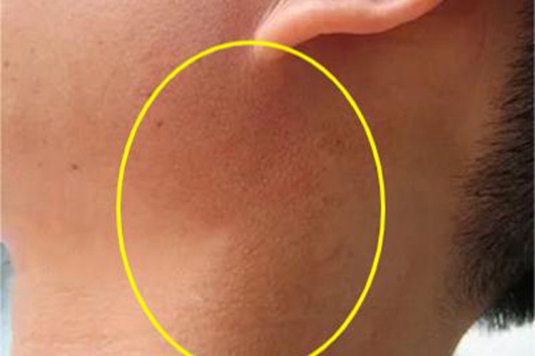焦油性黑变病耳周症状图 焦油性黑变病耳周症状图
