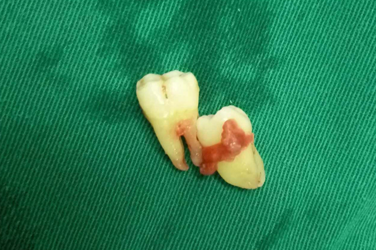 第二磨牙牙根图