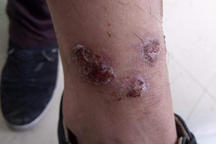脓窝疮脚踝有红色结痂图