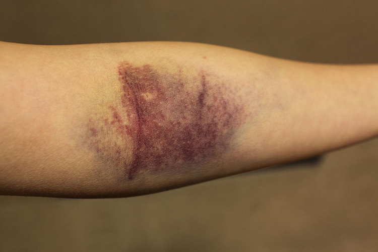 手臂轻微骨裂症状图 手臂轻微骨裂症状图