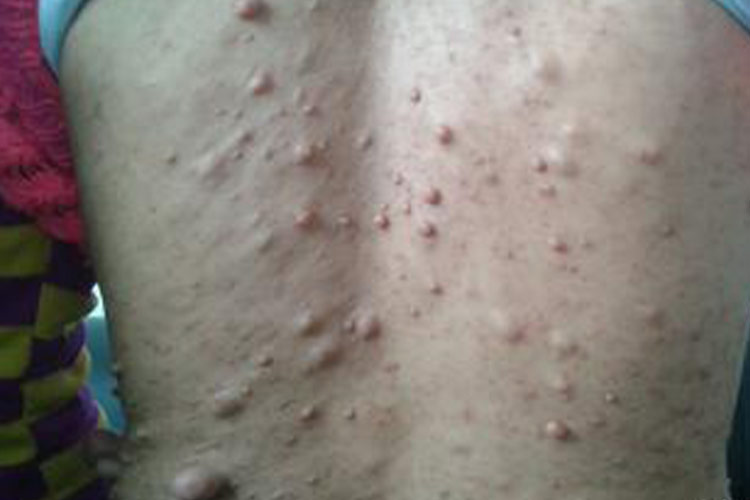 多发皮下脂肪瘤图