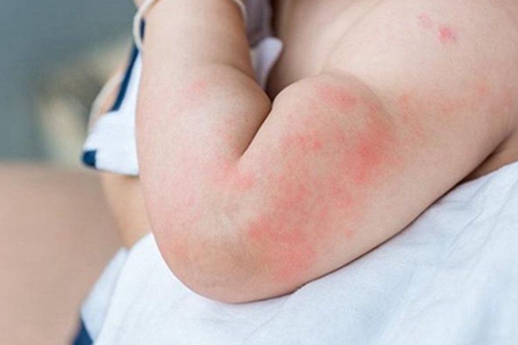 小儿海鲜过敏红斑丘疹图