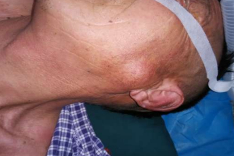 腮腺多形性腺瘤耳前大包图 腮腺多形性腺瘤耳前大包图
