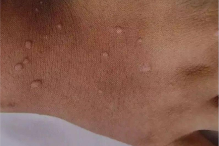 疣状肢端角化病手背小疙瘩图 疣状肢端角化病手背小疙瘩图