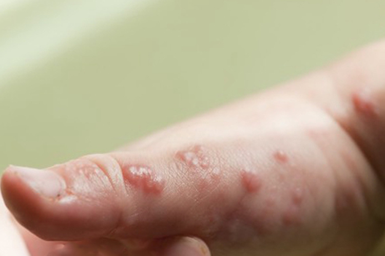 手部带状疱疹图 手部带状疱疹图