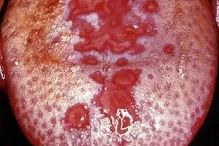 口腔梅毒舌头坑图