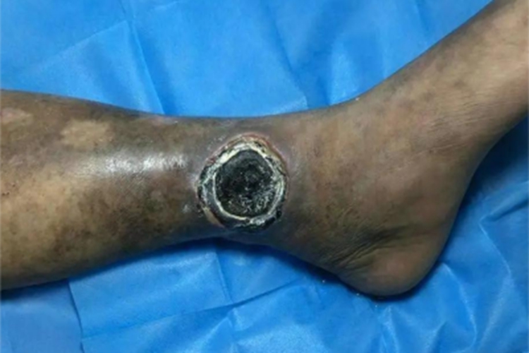 静脉曲张性溃疡小腿溃疡图 静脉曲张性溃疡小腿溃疡图