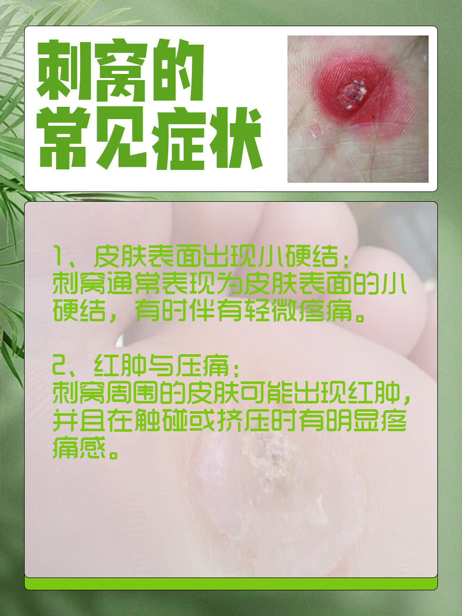 刺窝不再难缠，专业去除技巧大公开