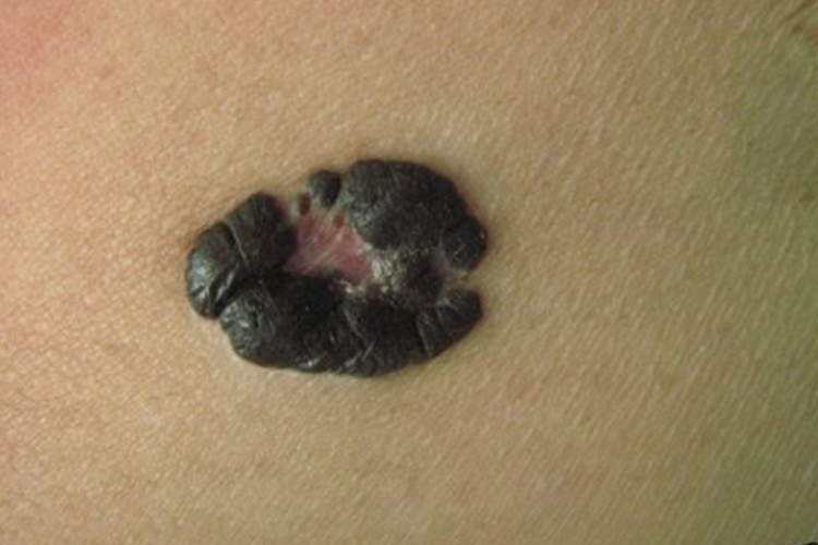 结节性黑素瘤图