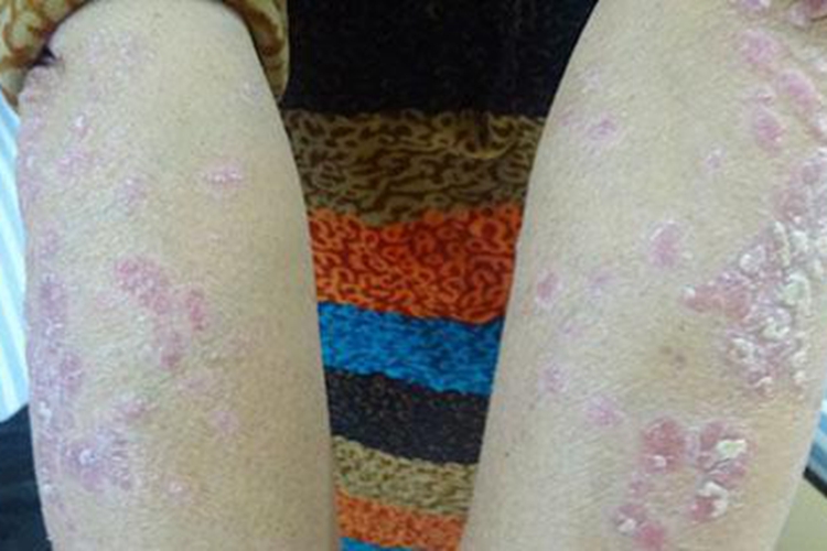 银屑病胳膊上起皮屑图