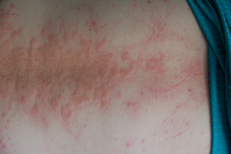 湿热毒引起的瘾疹图