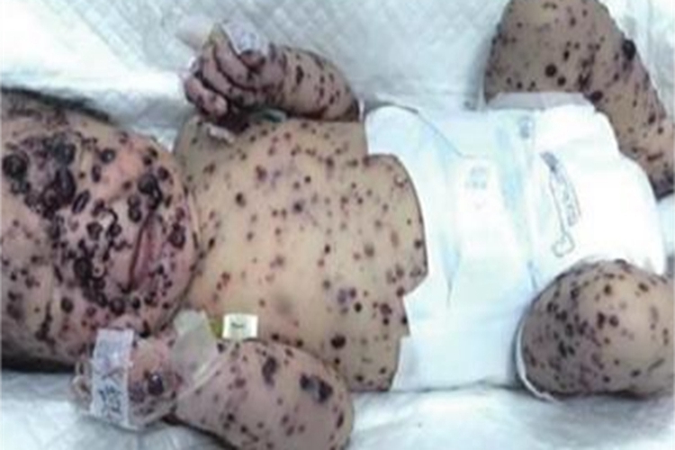 勒-雪病全身皮疹图