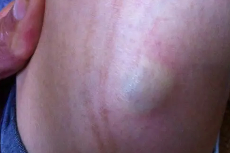 大腿脂肪瘤图 大腿脂肪瘤图