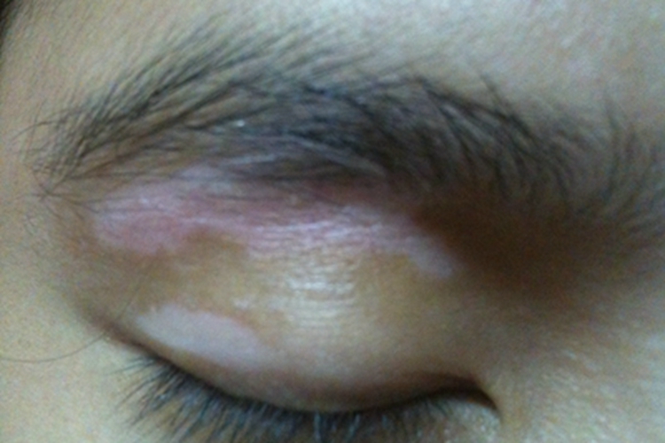 进展期节段型白癜风眼睑有白斑图