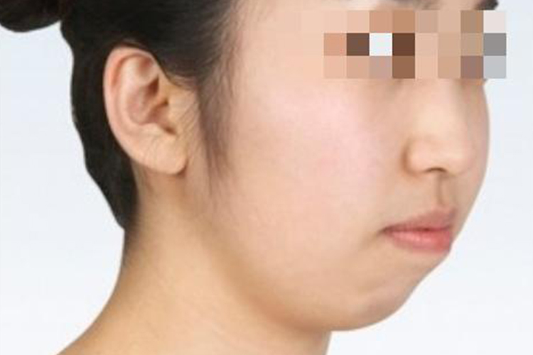 下颌后缩畸形面部图