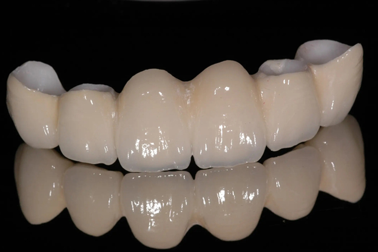 全瓷牙牙套图