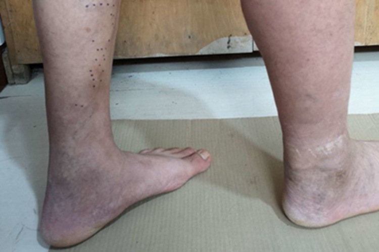 游走性血栓性浅静脉炎脚踝症状图