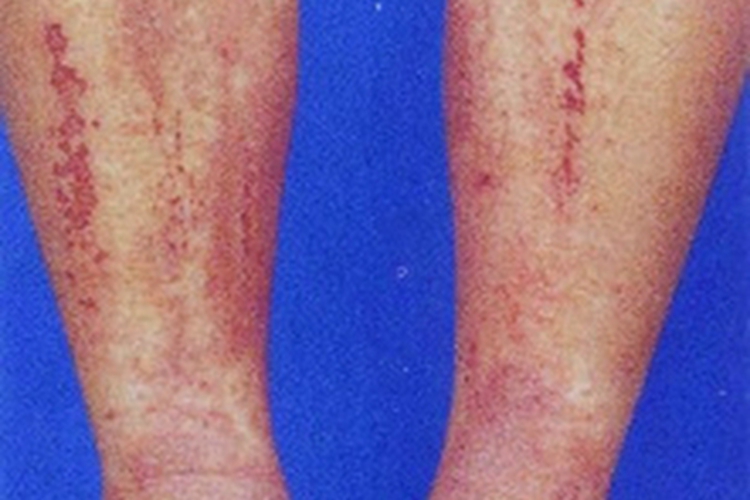 全身性瘙痒症小腿血痂图