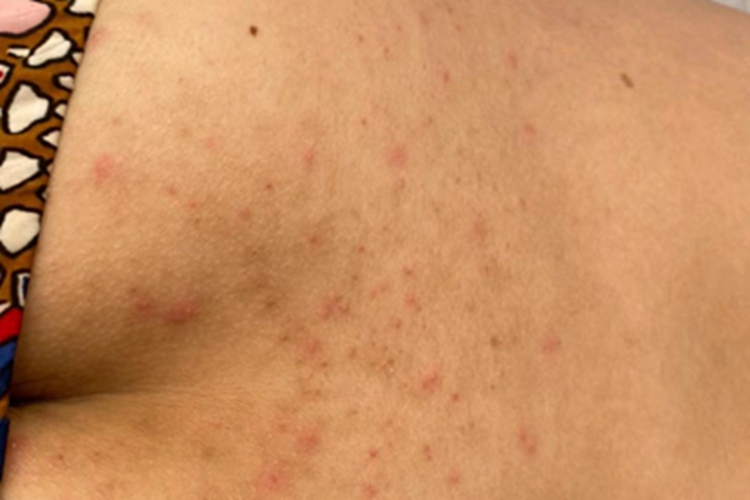 过敏性皮炎腰部小疙瘩图 过敏性皮炎腰部小疙瘩图