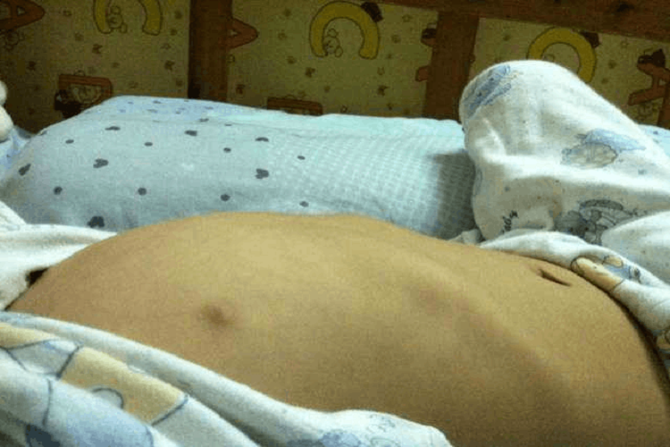 营养不良肋骨突出图 营养不良肋骨突出图